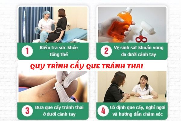 Quy trình cấy que tránh thai đúng chuẩn