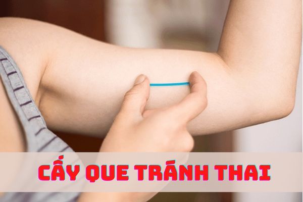 Cấy que tránh thai – Phương pháp ngừa thai ngoài ý muốn hiệu quả, hiện đại