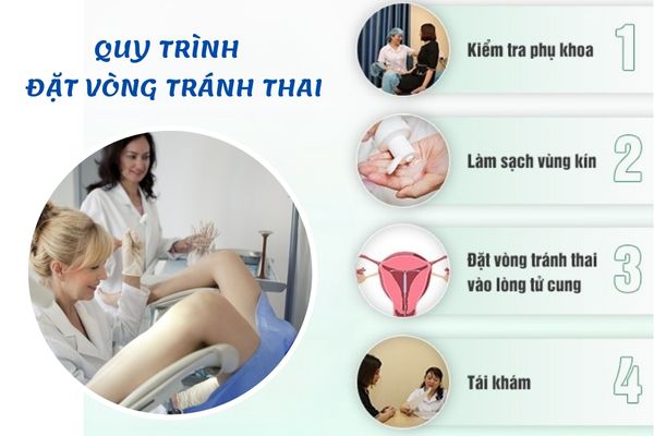 Quy trình đặt vòng tránh thai tiêu chuẩn