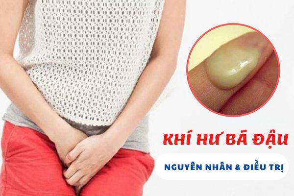 Khí hư bã đậu – Nguyên nhân và cách điều trị hiệu quả nhất nên biết