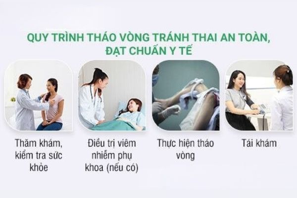 Quy trình tháo vòng tránh thai tiêu chuẩn