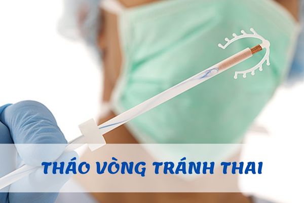 Tháo vòng tránh thai như thế nào? – Địa chỉ tháo vòng an toàn, hiệu quả