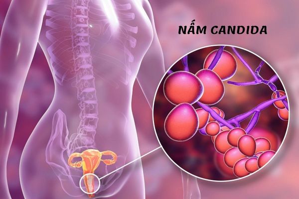 Nấm vùng kín do nấm Candida gây nên