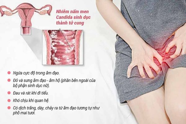 Nấm vùng kín có các biểu hiện rất dễ nhận biết