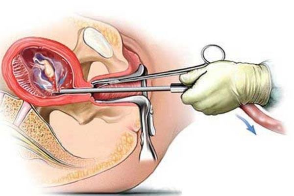 Nạo thai là một trong các phương pháp đình chỉ thai nghén phổ biến hiện nay