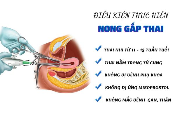 Thực hiện nong gắp thai cần đảm bảo đủ các điều kiện cần thiết