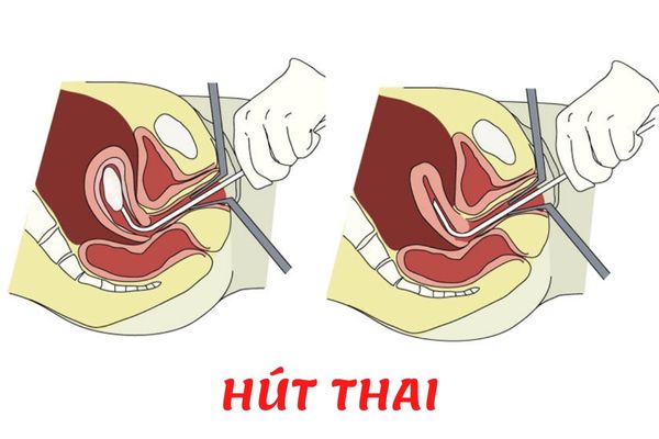 Phương pháp hút thai chân không đang được áp dụng phổ biến