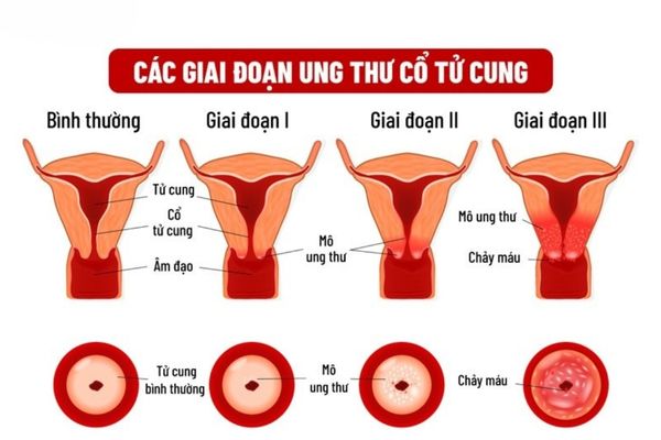 Các giai đoạn hình thành và phát triển của ung thư tử cung