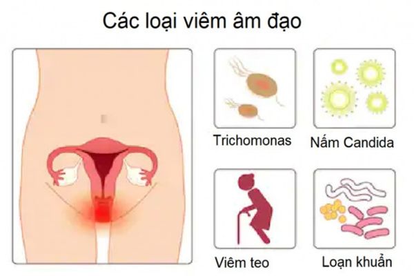 Viêm âm đạo do nhiều tác nhân gây ra