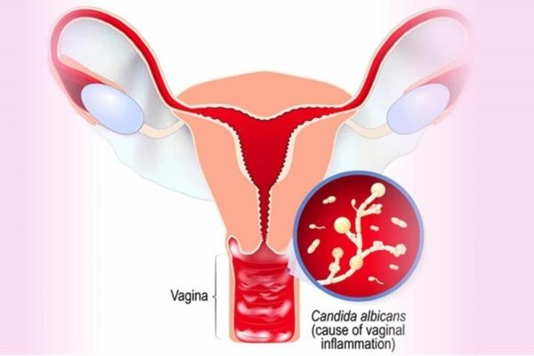 Tình trạng khí hư vón cục do viêm nhiễm âm đạo gây nên