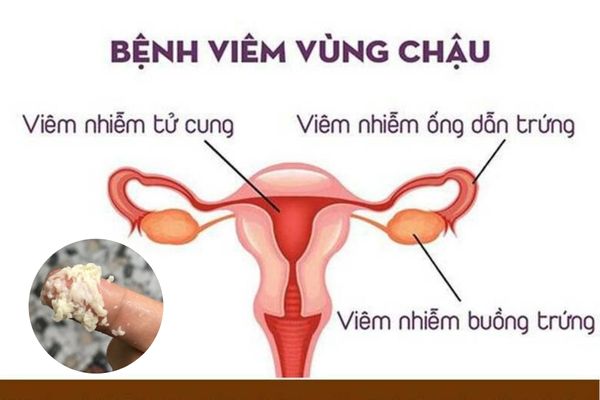 Viêm vùng chậu là bệnh lý nguy hiểm không nên xem thường