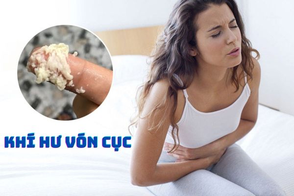 Khí hư vón cục – Dấu hiệu cảnh báo nhiều bệnh lý nguy hiểm