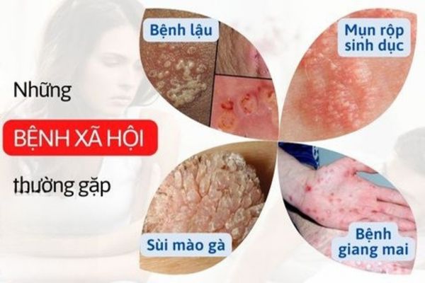 Bệnh xã hội gây ra tình trạng ngứa 2 bên mép vùng kín