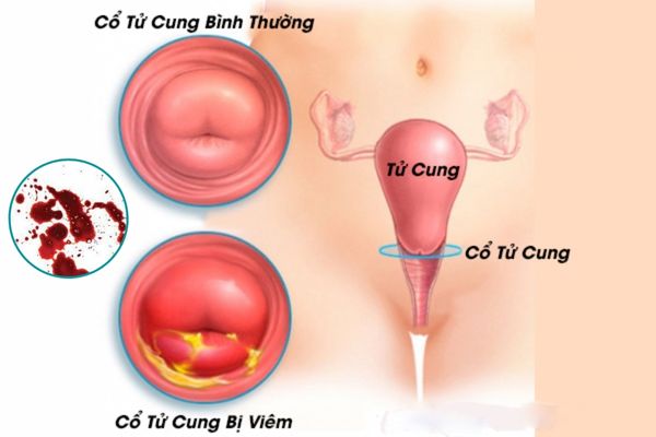 Quan hệ bị ra máu do viêm cổ tử cung