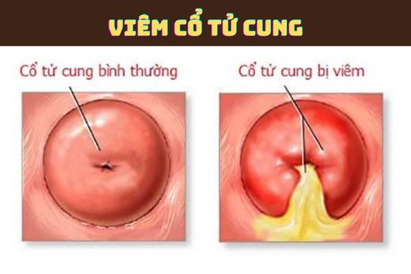 Viêm cổ tử cung - nguyên nhân gây ra máu khi quan hệ