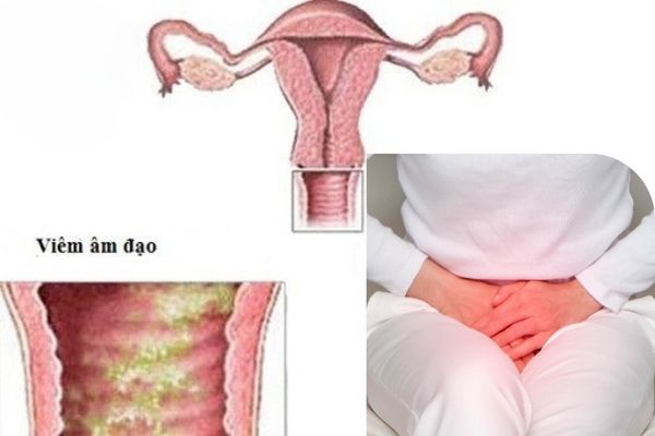 Quan hệ đau rát ở nữ giới do bị viêm âm đạo