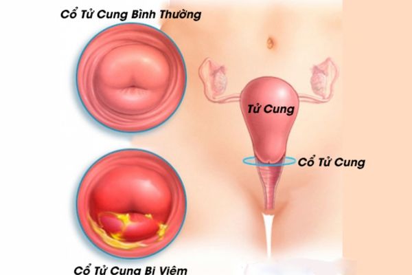 Viêm cổ tử cung - Bệnh lý nguy hiểm cần lưu ý