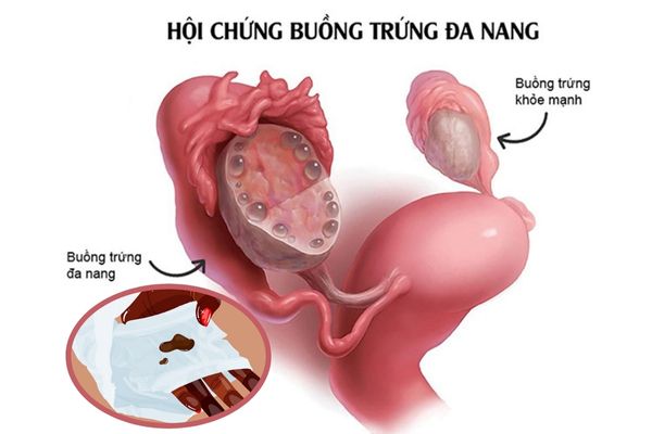 Âm đạo ra máu nâu do bị đa nang buồng trứng