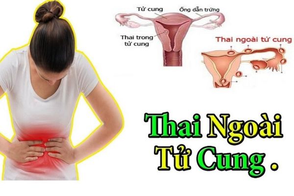 Đau bụng buồn nôn là dấu hiệu có thai ngoài tử cung