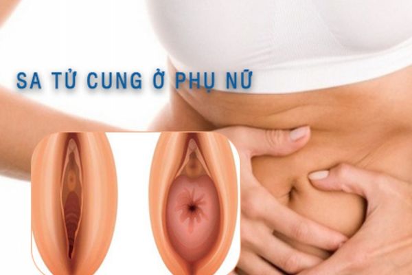 Sa tử cung dẫn đến tình trạng buồn nôn, đau bụng ở nữ giới