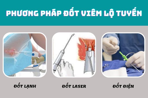 Các phương pháp đốt viêm lộ tuyến truyền thống