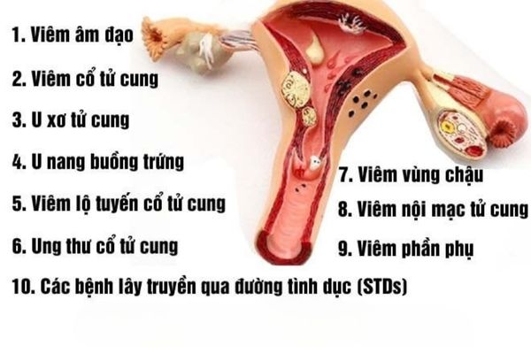 Trễ kinh do mắc các bệnh lý phụ khoa ở nữ giới