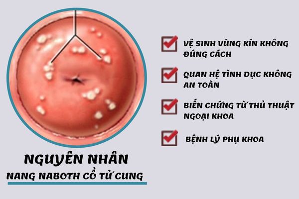 Nguyên nhân gây ra bệnh nang naboth tử cung cần lưu ý