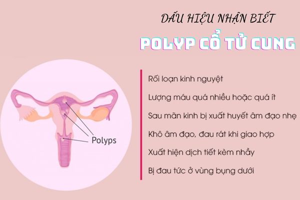 Các dấu hiệu nhận biết Polyp cổ tử cung chính xác, hiệu quả