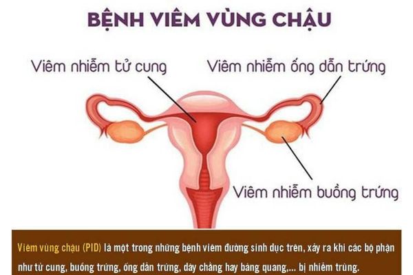 Quan hệ chảy máu do bị viêm vùng chậu