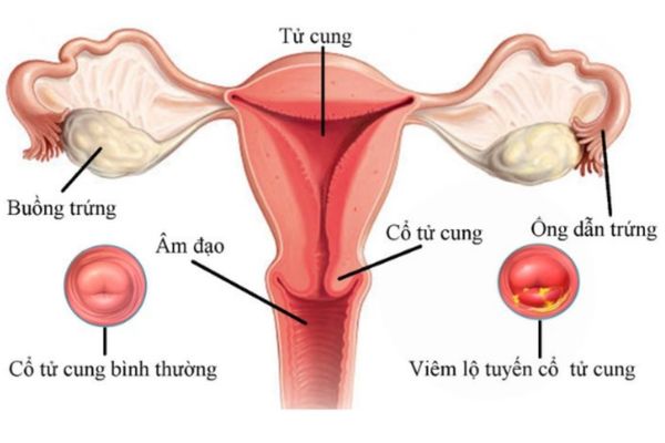 Quan hệ đau bụng kinh do mắc các bệnh lý tử cung/ cổ tử cung