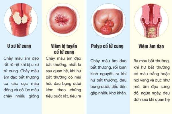 Ra máu đen cảnh báo nhiều bệnh lý phụ khoa nguy hiểm