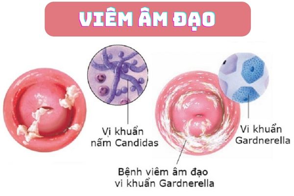 Sưng vùng kín là triệu chứng điển hình của bệnh viêm âm đạo