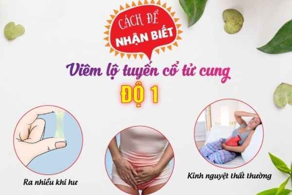 Dấu hiệu nhận biết bệnh viêm lộ tuyến cấp 1