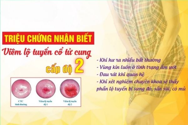 Triệu chứng nhận biết bệnh viêm lộ tuyến cấp 2