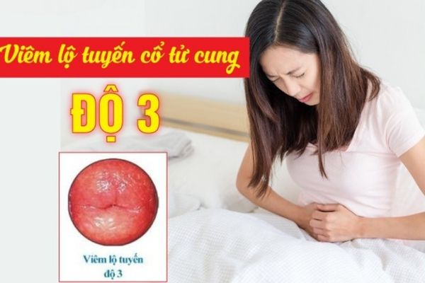 Bệnh viêm lộ tuyến cổ tử cung cấp 3