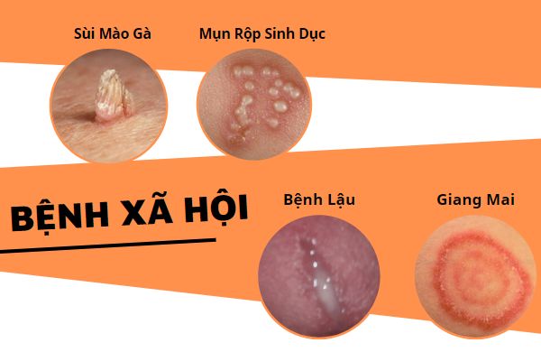 Diem-danh-cac-benh-vung-kin-de-gap-phai-nhat-04