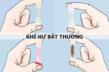 Khí hư có màu bất thường cảnh báo bệnh gì? Làm thế nào để khắc phục?